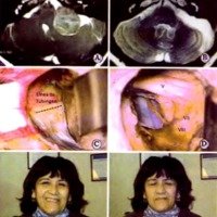 Fig. 10. Caso 19 del Cuadro 1. Paciente mujer de 54 años, con un tumor T4 b. A. IRM preoperatoria. B. IRM postoperatoria. C, imagen inicial, luego de reclinar el cerebelo, exponiendo la línea de Tubingen. D. Imagen del ángulo pontocerebeloso, con la preservación de los nervios facial y coclear, luego de la resección tumoral. E y F. Función facial postoperatoria.