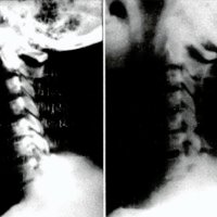 Fig. 2. FU de una osteofitodiscectomía C5-6 sin injerto. A) preoperatoria. B) postoperatoria.