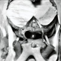 Anatomía Microquirúrgica del Segmento P1 de la Arteria Cerebral Posterior