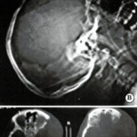Fig. 1. Hemicraniectomía descompresiva. B. Rx scout view. C. TAC ventana ósea. Remoción ósea basal