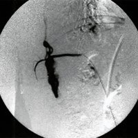 Fig. 3. Vista lateral de la inyección selectiva de D10 derecha la que muestra la localización medular anterior de la fístula