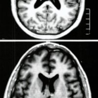 Fig. 2. IRM ponderarla en TI que muestra la resección tumoral.