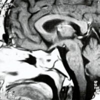 Fig 2. IRM Postoperatoria.