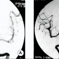 Fig 2. A. Angiografía digital de ambas arterias carótidas en incidencia frente a 48 hs de la HSA. Se observa segmento Ai hiploplásico derecho (flecha). B. El mismo paciente 90 días después del sangrado. Se observa la hipoplasia descartándose vasoespasmo por HSA.