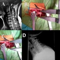 Figura 24: A: observamos hernia de disco C5-C6 en paciente joven con cervicobraquialgia. B y C: Discectomía con separador de caspar y colocación de cage. D: control radiológico.