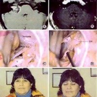 Fig. 7. Caso 12 del Cuadro 1. Paciente mujer de 49 años, con un tumor T4 a. A. IRM preoperatoria. B. IRM postoperatoria. C. Imagen del ángulo pontocerebeloso, con la preservación de la vena petrosa superior, luego de la resección tumoral. D. Imagen del ángulo pontocerebeloso, con la preservación del nervio facial, luego de la resección tumoral. E y F. Función facial postoperatoria.