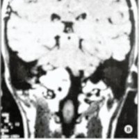 Fig. 8. A. TAC. B. IRM preoperatoria mostrando cordoma de clivus, con extensión al cóndilo derecho. C. TAC postoperatoria. '