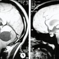 Fig. 1. IRM de cerebro en T1 donde se observa lesión ocupante de espacio cerebelosa, hipointensa con nódulo periférico que realza con gadolinio. A. Sin gadolinio. B. Con gadolinio.