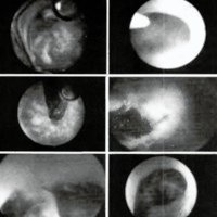 Fig. 4. Fotografías endoscópicas intraoperatorias.