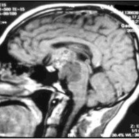 Fig. 9. IRM preoperatoria corte sagital