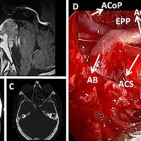 Figura 36: Abordaje transclival. A y B) Ilustran las imágenes en RMNT1 con gadolinio preoperatorias que evidencian un cordoma del tercio superior del clivus. B y C) Imágenes en TC postoperatorias que evidencian la resección completa y la extensión de la remoción ósea. Se aprecia en B la reparación mediante un HBF. D) Imagen intraoperatoria en la que se observa la arteria basilar (AB), las arterias cerebrales posteriores (ACP), se aprecia la emergencia de la arteria comunicante posterior (ACoP) y la salida de la art. Cerebelosa superior (ACS). Entre la ACP y la ACS se objetiva la emergencia del nervio motor ocular común (III). Nótese las perforantes naciendo del tope de la basilar e ingresando al espacio perforando posterior (EPP).