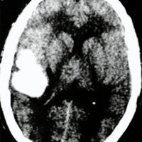 Fig. 1. tomografía axial computada objetiva hematoma intraparenquimatoso témporo-parietal derecho.