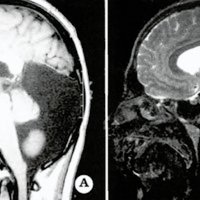 Fig. 1. A. Preoperative T1- weighetd sagittal MRI showing retrocerebellar arachnoid cyst. B. Note theflow void (arrow) through cystocisternostomy on postoperative T2-weighted sagittal MRI.<br />
