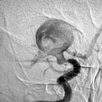 Figura 2: Angiografía de carótida derecha. Aneurisma de la bifurcación de la arteria carótida interna derecha que puso en peligro las dos ramas del tenedor.