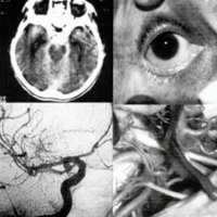 Fig. 2. Parálisis del NMOC por aneurisma de la arteria comunicante posterior.