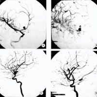 Fig. 3. Malformación arteriovenosa de A2. A, B y C. Angiografias preoperatorias. D. Angiografia postoperatoria
