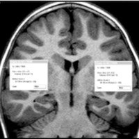 Fig. 14. Examen volumétrico de ambos hipocampos. (Fundación Científica del Sur).