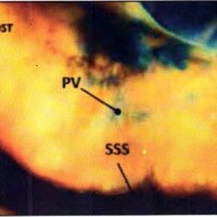 Fig. 11. Hoz del cerebro inyectada y también por transiluminación donde se puede observar un plexo venoso (PV) tipo I en tercio posterior de SSS.<br />
