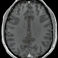 Figura 4: RM de cerebro 20 meses post operatoria. Secuencia T1 con gadolineo. Corte axial. Sin realce a nivel parietal izquierdo en zona de evacuación de lesión abscedada y sin edema