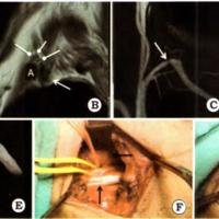 Síndrome del outlet torácico: ¿una patología siempre quirúrgica? Análisis de una serie de 31 cirugías realizadas por vía supraclavicular