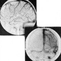 Fig. 6. Angiografía cerebral en tiempo venoso frente y perfil izquierdo.