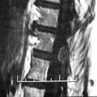 Fig. 3. Meningioma de la columna dorsal, en corte sagital.