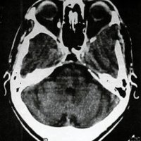 Fig. 3. Imagen tumoral intraoperatoria.