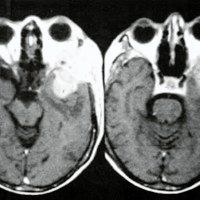 Fig. 5. IRM que muestra tumor en la fosa temporal.