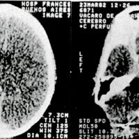 Figura 5. TC post-derivación Lumbo-peritoneal. Se observa corrección de la hidrocefalia y desaparición del pseudomeningocele.