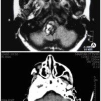 Fig. 4. A. IRM prequirúrgica en un cavernoma de bulbo. B. TAC postcirugía.