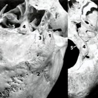 Fig. 4. Reparos óseos. 1: mastoides, 2: asterion, 3: eminencia ywctamastoidea, 4: cóndilo occipital, 5: canal del hipogloso, 6: orificio estilomastoideo