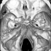 Fig. 1. Control postoperatorio paciente con aneurisma paraclinoideo clipado. Se observa la resección de la clinoides anterior