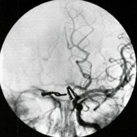Fig 5. Left carotid angiogram on admission: no aneurysm seen