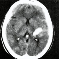 Fig. 1. TAC que muestra un hematoma talámico izquierdo