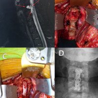 Figura 25: A: observamos hernia de disco C5-C6 en paciente joven con cervicobraquialgia. B y C: Discectomía con separador de caspar y colocación de cage. D: control radiológico.