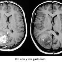 Figura 3: RM de cerebro con y sin contraste.