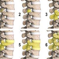 Osteotomías lumbares de columna posterior: Anatomía quirúrgica en fotografías 3D