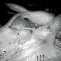 Fig. 2: Vista póstero -lateral de Seno Cavernoso y Espacio Clinoideo, Los pares craneales ( m, IV, VI y VI) son expuestos en la pared lateral del Seno Cavernoso, La membrana carotídea-oculomotora ( com ) extensión de la dura del anillo carotideo proximal.