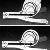 Fig. 9. Esquemas de aneurismas experimentales de la bifurcación aórtica del conejo según Ujiie et al. A. Aneurisma mediano. B. Aneurisma grande (>5 mm) El tipo circulatorio básico es el mismo, pero en los grandes, una separación de las corrientes de la pared antes de llegar al fondo, genera vórtices secundarios contrarrotatorios y lentos, que producirían daño de la pared. La dificultad de salida, aumenta la presión dentro del saco.