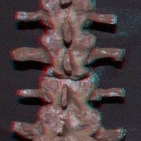 Figura 5: Vista posterior. Osteotomía de Grado 2. Resección completa de ambas facetas en forma bilateral. El canal formado adquiere la forma de una “V”. En el fondo, se observa el saco dural.