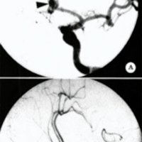 Fig. 1. Angiografía carotídea izquierda en oblicua: A. aneurisma comunicante anterior (flecha); B. Control postembolización que muestra oclusión completa del aneurisma con microespirales (flecha).