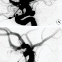 Fig. 6. A. Angiografía digital de la arteria carótida interna que muestra un aneurisma pequeño de cuello grande. B. Control postembolización que muestra una oclusión tipo B.