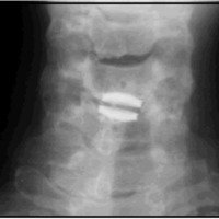 Fig. 2. Radiografía simple de frente que muestra en el caso 2 la alineación coronal del implante en C5-C6.