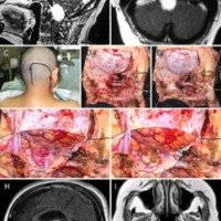 Figura 3: A-B) RM preoperatorias que muestran un meningioma del FM anterior. C-G) Fotos quirúrgicas de la paciente. H-I) RM postoperatorias, con resección completa de la lesión. A: arteria; Art: articular.