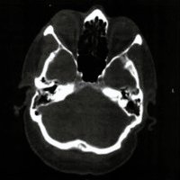 Fig. 5. Paciente sexo masculino operado de 63 años de edad. Corte axial de tomografia computada (ventana ósea) a los 48 meses de postoperatorios con marcada reosificación de la craniectomía izquierda.<br />
