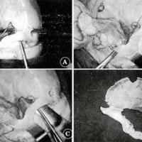 Fig. 3. A) Pase de sierra frontal. B y C) Pases de sierra malares. D) Plaqueta ósea cara interna.