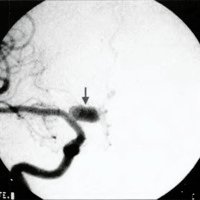 Fig. 3. Angiografía digital de la arteria carótida interna derecha en proyección frente. Se observa aneurisma fusiforme de segmento A (flecha).