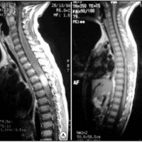 Fig. 4. A. IRM: imagen sagital en T1 que muestra lesión cervical intramedular a nivel T4- T5 con refuerzo del contraste y marcado edema medular que corresponde a un histoplasmoma. B. IRM: imagen sagital en T1 con gadolinio un mes después de la cirugía que muestra la resección completa del histoplasmoma