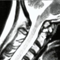 Fig. 3. IRM cervical sagital T2 preoperatoria. Nótese la presencia de los osículos y la compresión bulbomedular.