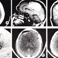 Fig 2. A. TAC cerebral con contraste extenso meningioma parasagital de 10,5 cm de diámetro mayor. B. IRM con gadolinio en corte parasagital. C. Corte coronal. D. Angiografía con blush en la parte inferior. E y F. TAC postopeatoria: exéresis total Simpson 2.